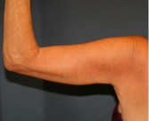 Feel Beautiful - Arm Reduction 213 - After Photo